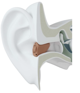 Hearing-Aid-Type-5-Completely in canal